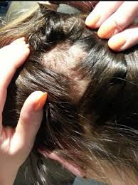 Hair follicle test samples can be collected from several locations on the head and combined to get the necessary amount of hair for a sample testing. Ketamine Probe Leads To Barbaric Ambulance Victoria Drug Tests