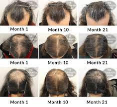 Male pattern baldness is inevitable for most men. Success Story Alert New Male Pattern Baldness Entry
