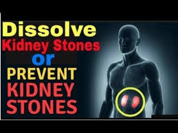 Kidney Stones Break The Stones And Prevent Them In The Future With These Natural Remedies Youtube Kidney Stones Kidney Stones Remedy Natural Remedies