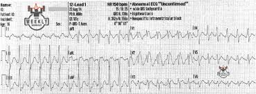 Image result for Sodium Channel Blocker