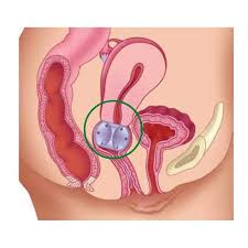 Image result for Pessary