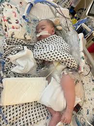 Jax's sedation and ventilator settings improved