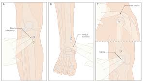 Image result for Intraosseous Access