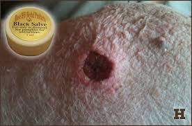 This is the scientific term for the cells that are the inner lining of veins, arteries, and capillaries. Hemangiosarcoma In Dogs Caninecancerdiet Com