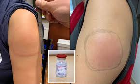 Aside from sometimes being itchy, it doesn't appear to be dangerous, and. Rare Covid Arm Side Effect Leaves People Who Got Moderna S Shot With Itchy Red Splotch Daily Mail Online