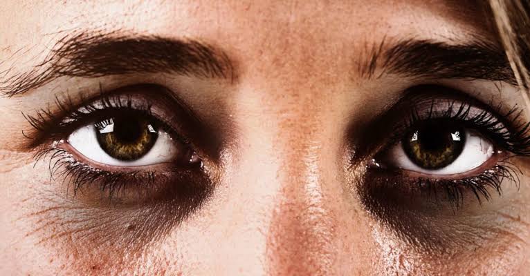 Dark Circles under Eyes