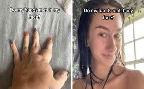 Šta je vaskularna malformacija: TikToker podiže svijest o rijetkim urođenim  manama