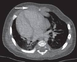 Poland syndrome is a birth defect characterized by an underdeveloped chest muscle and short webbed fingers on one side of the body. Left Sided Poland S Syndrome Associated With Dextrocardia Abstract Europe Pmc