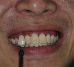 Cases Of In Office Bleaching Prestige Dental Care