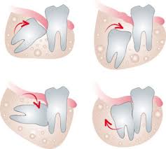 How much does wisdom teeth removal cost? Impacted Tooth Extraction Wisdom Tooth Extraction In Hyderabad India Focus Dental Care