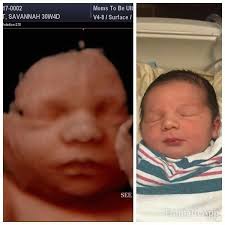 We do not perform medical ultrasounds. Before And After 3d Ultrasound Images