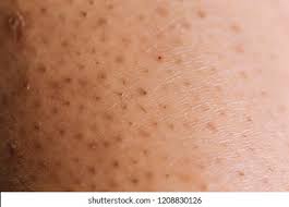 Does a deep bumpy growth under skin mean it is an infected ingrown hair cyst? Closeup Caucasian Skin Ingrown Hair Stock Photo Edit Now 1208830126