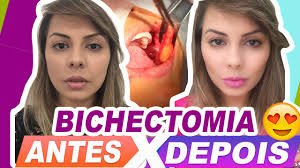 Aproveitando este artigo eu vou responder ao email enviado pela sueli de campo grande que fez a seguinte pergunta: Bichectomia Gravatai Rs R Coronel Fonseca 772 Gravatai 2021
