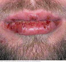 Stevens Johnson Syndrome Symptoms And Causes Mayo Clinic