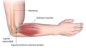 Pain, swelling, and redness of the forearm are the most commonsymptoms of the condition. Physiotherapy For Elbow And Forearm Pain Glebe Physio