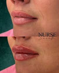 Who does @davidhalsall trust with his Aesthetic treatments? Nurse Sarah  🥺🙌🏼💉all ready for the @nationalbeautyawards this month 🥳 David has had  Chin, Jaw & Cheek filler to masculinise his face, he gets