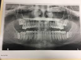 Because you are not likely to be qualified to determine if you indeed have a cavity, you will need a dentist to do this. First Signs Of Wisdom Teeth Coming In Reddit Teethwalls