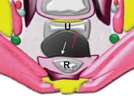 She has long brown hair and stunning brown eyes. Mri Of Tumors And Tumor Mimics In The Female Pelvis Anatomic Pelvic Space Based Approach Radiographics