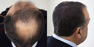 Ckm Super Billion Hair Ile Sadece 10 Saniyede Saca Hacim Kazandirin Sac Keratin Essiz