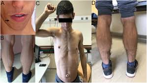 Frosch m., kautz g., reers b. Successful Long Term Use Of Pioglitazone In Berardinelli Seip Lipodystrophy Associated Diabetes In Endocrinology Diabetes Metabolism Case Reports Volume 2021 Issue 1 2021