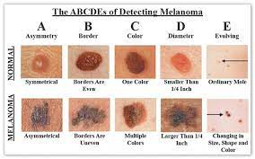 skin cancer accounts for more diagnoses each year than all other cancers, but the good news is that early detection could be the difference between a simple mole removal or malignant cancer that. How To Check For Skin Cancer Skin Care Network