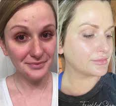 Happy almost Summer ☀️ Haley, owner + Aesthetician of Freckled Skin Studio  Med Spa. With over 12 years of experience, l'm passionate about helping you  achieve *real* results through science-backed treatments and