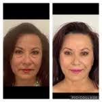 Facelift/Neck Lift Albuquerque NM, D. Eric Tuggle, D.D.S.