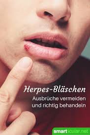 Ich habe die die grippe hingegen verläuft wesentlich schneller und stärker in ihren symptomen. Lippenherpes Richtig Behandeln Und Vorbeugen Alle Tipps Und Tricks