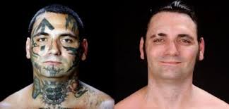 Reformed Skinhead Endures Agony to Remove Tattoos