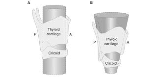 The Pediatric Airway And Rapid Sequence Intubation In Trauma