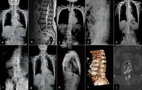 The major muscles of the abdomen include the rectus abdominis in front the external obliques at the sides and the latissimus dorsi muscles. A 67 Year Old Female Patient With Low Back Pain For 5 Years With Download Scientific Diagram