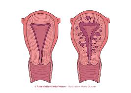 Women with endometriosis or adenomyosis had a higher odds of preterm delivery and having a child that was sga compared with women without endometriosis or adenomyosis. Adenomyosis Symptoms Diagnosis Treatment Ifem Endo