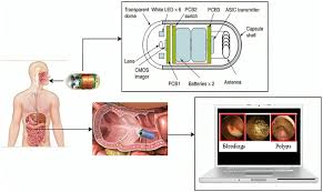 Image result for Wireless Capsule Endoscopy