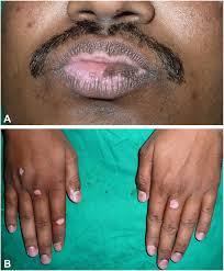 Image result for Vitiligo