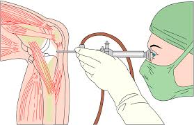 Check spelling or type a new query. Tales Of A Torn Meniscus Do They All Need Surgery Leading Edge Physiotherapy St Albert Edmonton Physical Therapy