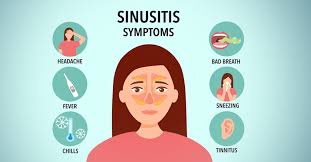 Image result for Sinusitis Prediction Rule