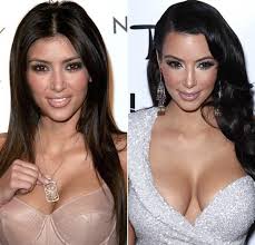 Resultado de imagem para before after surgery