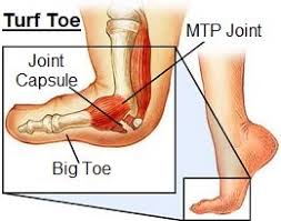Turf toe is essentially a sprain or hyperextension of the toe. Turf Toe Physiotherapy