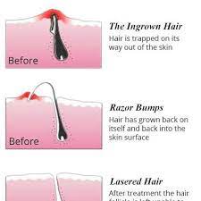 The best way to prevent it is by not shaving or waxing your pubic hair at all. Ever Got Painful Itchy Red Bumps Or Ingrown Hairs After Waxing Waxing Shaving Threading Cause Trauma To Hair Shaft Inside Your Skin Few Of Them Curls Inside The Skin And Fails To Come Out Causing