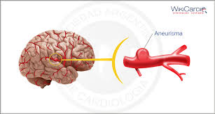 O coração , incluindo aneurismas da artéria coronária , aneurismas ventriculares , aneurisma do seio de valsalva , e aneurismas após cirurgia cardíaca. O Que E Aneurisma Cerebral Abdominal Etc Sintomas Tem Cura Terceira Idade
