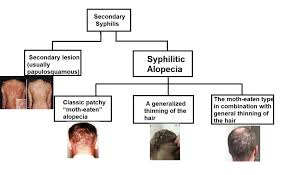 It's important to take medicine to cure. Does Acyclovir Cause Hair Loss