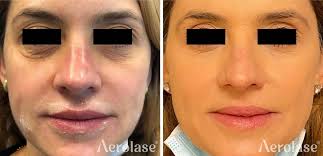Transforme la salud de la piel con la tecnología avanzada de Aerolase