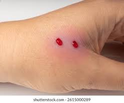 Image result for Human Bite