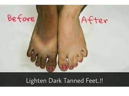 Remove Sun Tan From Your Feet Lighten Dark Tanned Feet Sayantani S Tan Removal Skin Tan Removal Tan Removal Home Remedies
