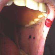 They typically occur when the outer layer of the skin is damaged. Heparin Induced Bullous Hemorrhagic Dermatosis Confined To The Oral Mucosa Mdedge Dermatology