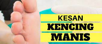 Walaupun penyakit kencing manis telah lama diketahui, kawalan penyakit kencing manis yang berkesan hanya diketahui pada 1921 apabila frederick g. Kesan Kesan Buruk Kencing Manis Clear Herbs
