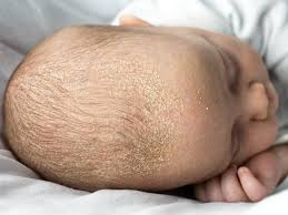 Image result for white scabs on the head in children