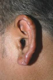 Borderline tuberculoid leprosy patients have anesthetic discrete plaques similar to those in tuberculoid leprosy. What Is Your Diagnosis Lepromatous Leprosy Mdedge Dermatology