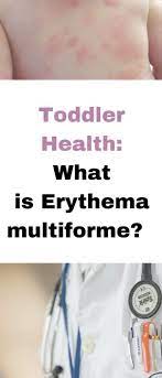 Erythema Multiforme A Possible Allergic Reaction Amoxicillin Allergic Reaction Rash Amoxicillin Rash Toddler Health