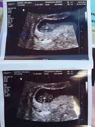 Portofrei ab 50€, lieferung in 48h! 6 Weeks Ultrasound Pictures March 2019 Babies Forums What To Expect